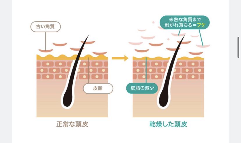 頭皮が乾燥するのはなぜ？/原因と対処法/那覇美容室